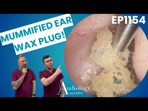 Видео: Извлечение мумифицированной ушной серы – вы не поверите! - EP1154