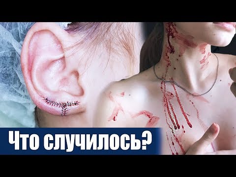 Видео: ЧТО С МОИМИ УШАМИ? пластика мочек. разошлись швы?