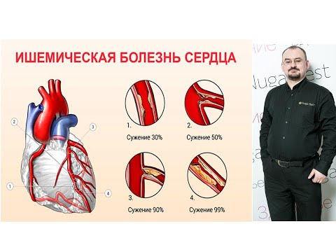 Видео: Ишемическая болезнь сердца – проявления