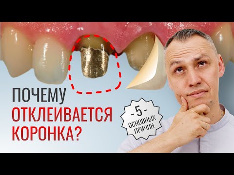 Видео: 5 ПРИЧИН ПОЧЕМУ ОТКЛЕИВАЕТСЯ КОРОНКА