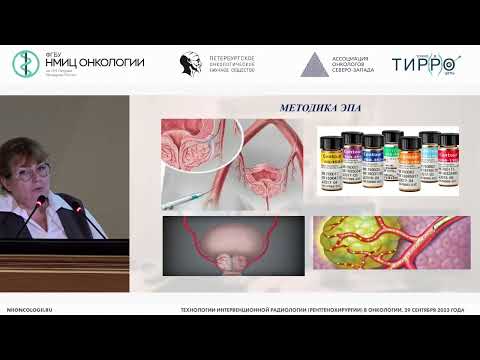 Видео: Алгоритм использования эмболизации простатических артерий у больных раком предстательной железы