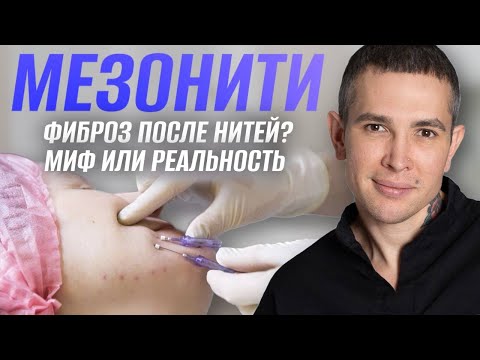 Видео: НИТЕВОЙ ЛИФТИНГ ФИБРОЗ Миф или Реальность? | Споры с пластическими хирургами #нитевойлифтинг #радиес