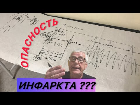 Видео: ЭКГ электрокардиограмма простыми словами