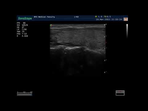 Видео: УЗИ щитовидной железы. Пациент 2