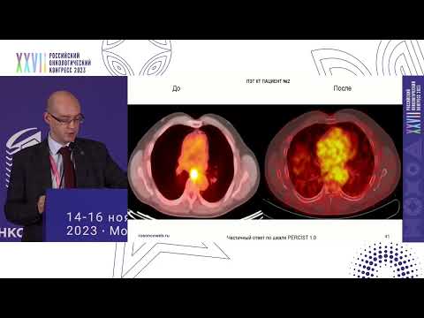 Видео: Готовы ли мы к интеграции иммунотерапии в лечение резектабельного рака пищевода?