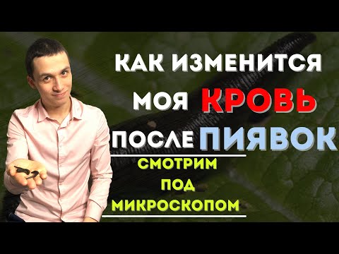 Видео: Как ставить пиявки в домашних условиях!? Польза «Гирудотерапии»