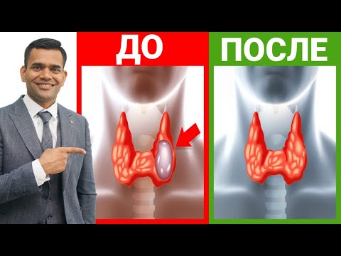 Видео: Как Уменьшить Узлы Щитовидной Железы Естественным Путем | Доктор Вивек Джоши