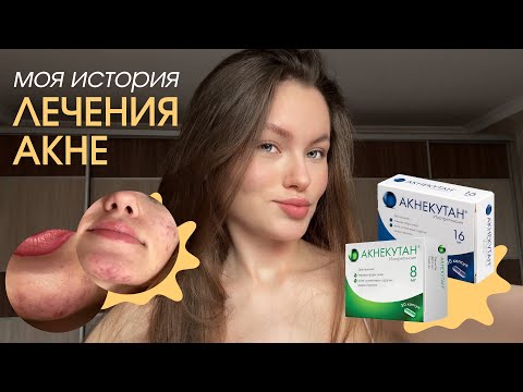 Видео: РЕТИНОИДЫ: 3 месяца спустя — мой честный отзыв, побочки и результат | лечение акне