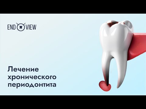 Видео: Хронический периодонтит — лечение, симптомы и причины