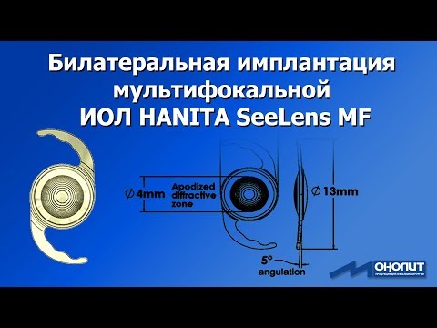 Видео: Опыт билатеральной имплантации мультифокальной ИОЛ Hanita SeeLens MF