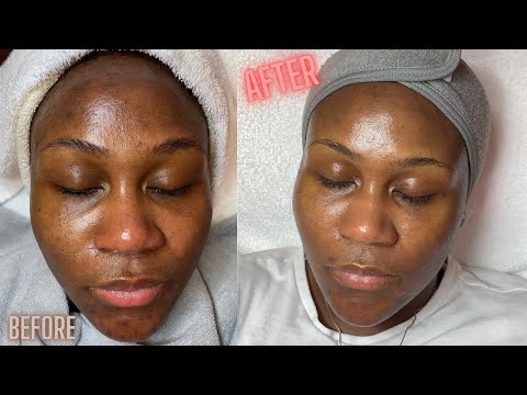 Видео: Коррекция гиперпигментации с помощью микродермабразии