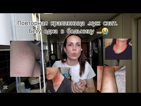 Видео: Тут рассказываю о повторной крапивнице😭в сентябре 2025 года  и как спасти себя первые пол часа #влог