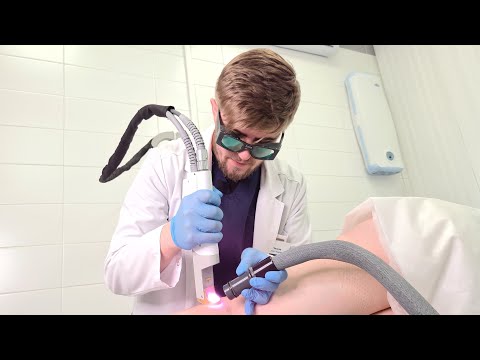 Видео: Трансдермальный лазер или склеротерапия: что лучше для удаления сосудистых звездочек?