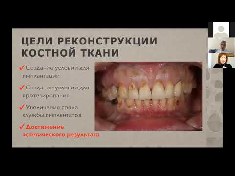 Видео: Современные методы реконструкции альвеолярной кости