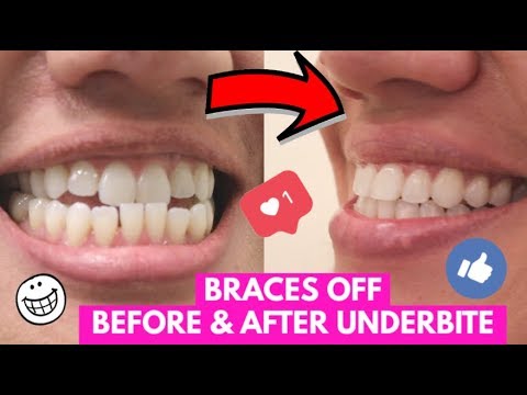 Видео: СНЯЛИ БРЕКЕТЫ, ИСПРАВИЛИ ПРИКУС! Снимаю брекеты и исправляю прикус.