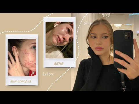 Видео: КАК Я ВЫЛЕЧИЛА ПРЫЩИ? | акне, уход, гормоны, роаккутан