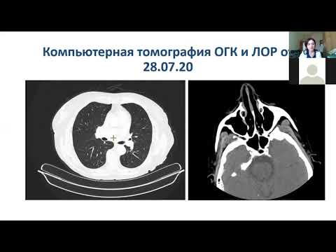Видео: Клинический разбор : "Гранулематоз Вегенера"