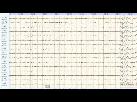 Видео: Приступ эпилепсии во время записи ЭЭГ