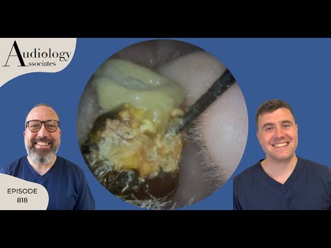 Видео: Набор для удаления ушной серы, включая карманы для ретракции барабанной перепонки - EP818