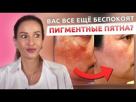 Видео: 5 эффективных способов убрать пигментные пятна. Что нельзя делать.