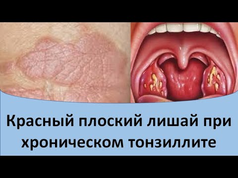 Видео: Красный плоский лишай при хроническом тонзиллите