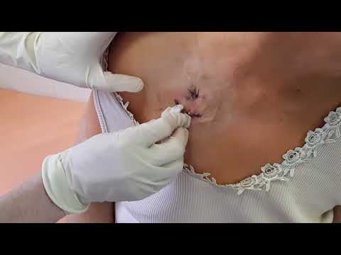 Видео: 015. Подкожный венозный порт. Что это? И для чего нам это знать?