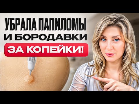 Видео: 3 ПРОСТЫХ способа избавиться от папиллом НАВСЕГДА! / Как БЫСТРО и безопасно избавиться от ПАПИЛЛОМ?
