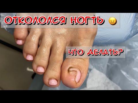 Видео: Живой прием. Как правильно выбрать обувь / Почему не прирастает ноготь / на ноге сломался ноготь