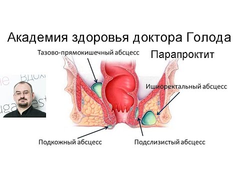 Видео: Парапроктит и его лечение.