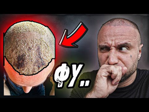 Видео: 10 ДНЕЙ ПОСЛЕ ПЕРЕСАДКИ ВОЛОС