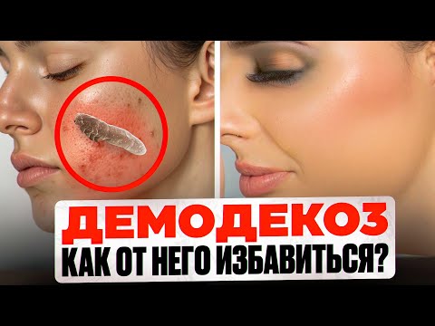 Видео: Демодекоз, как от него избавиться?