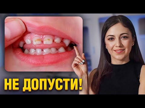 Видео: Почему появляется кариес и как его избежать? ВАЖНЫЕ СОВЕТЫ ОТ ДЕТСКОГО СТОМАТОЛОГА