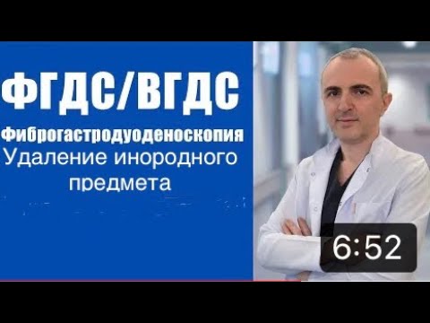 Видео: Гастроскопия, эндоскопическое удаление инородного предмета-стоматологического инструмента из желудка