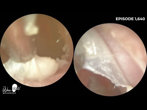 Видео: 1,640 - Точный пилинг омертвевшей инфицированной кожи уха