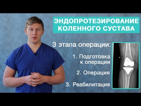 Видео: Эндопротезирование коленного сустава. Подготовка, проведение эндопротезирования, реабилитация