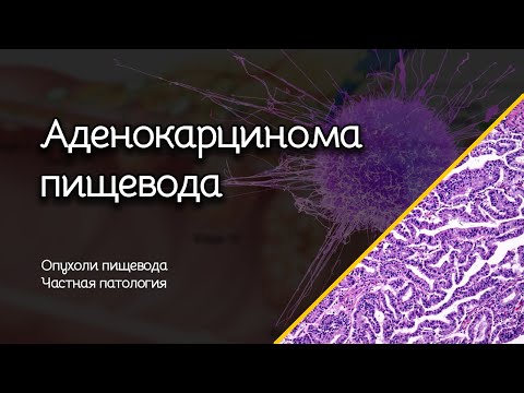 Видео: Аденокарцинома пищевода | Опухоли пищевода | Частная патология