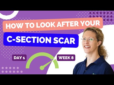 Видео: Терапия HLP: как ухаживать за рубцом после кесарева сечения с первого дня до восьмой недели