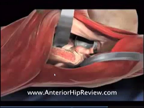 Видео: Ендопротезиране на коленни и тазобедрени стави