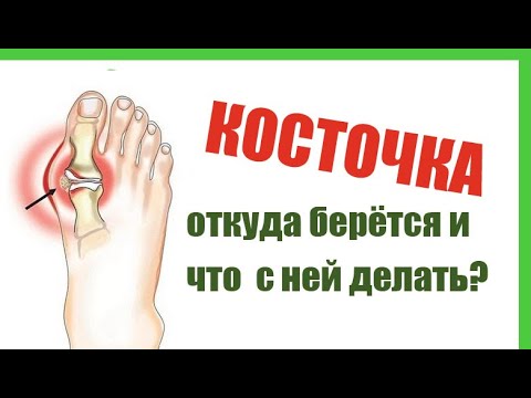 Видео: Поговорим о поперечном плоскостопии