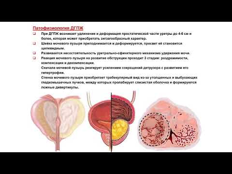 Видео: УЗИ. Доктор Иогансен. Выпуск 115.  Доброкачественная гиперплазия предстательной железы. Часть 1.