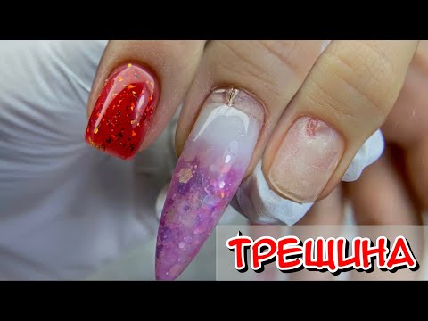 Видео: Онихорексис / Трещина на ногте / вертикальные трещины на ногтях рук / продольные трещины на ногтях