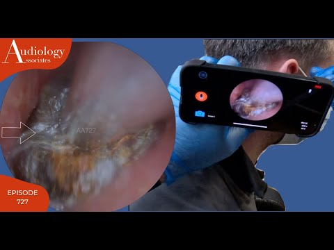 Видео: ЧРЕЗВЫЧАЙНО СЛОЖНОЕ УДАЛЕНИЕ УШНОЙ СЕРЫ - С ВИДОМ НА ПАЦИЕНТА - EP727