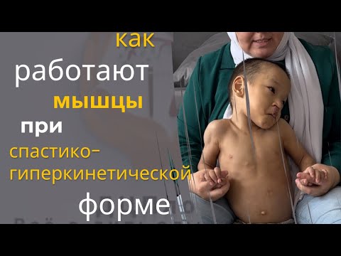 Видео: Как работают мышцы при Спастико-гиперкинетической форме