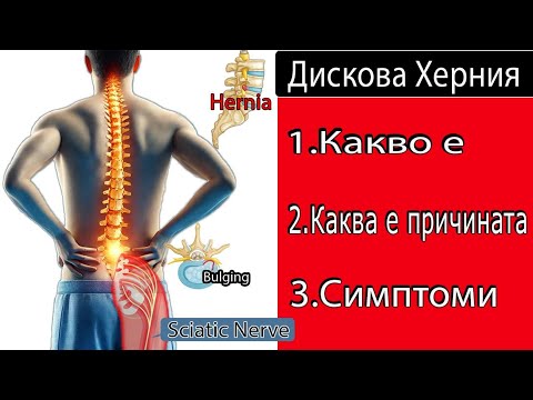 Видео: Защо всъщност се появява дискова херния? Ето причината!