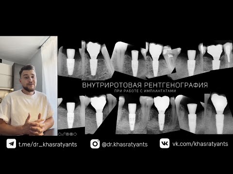 Видео: ВЕБИНАР: "Внутриротовая рентгенография при работе с имплантатами"