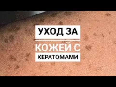 Видео: Уход за кожей с кератомами.
