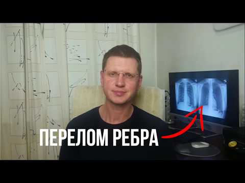 Видео: Как лечить перелом ребра?