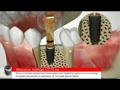 Видео: AnyRidge, протокол сверления костной ткани типа D1