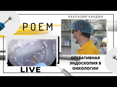 Видео: Ахалазия кардии. POEM прямая трансляция "Оперативная эндоскопия в онкологии"