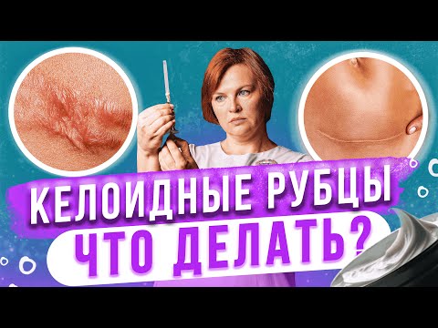 Видео: Келоидные рубцы. Что точно не стоит делать?